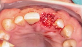 Заполнение лунки материалом Ivory Dentin Graft